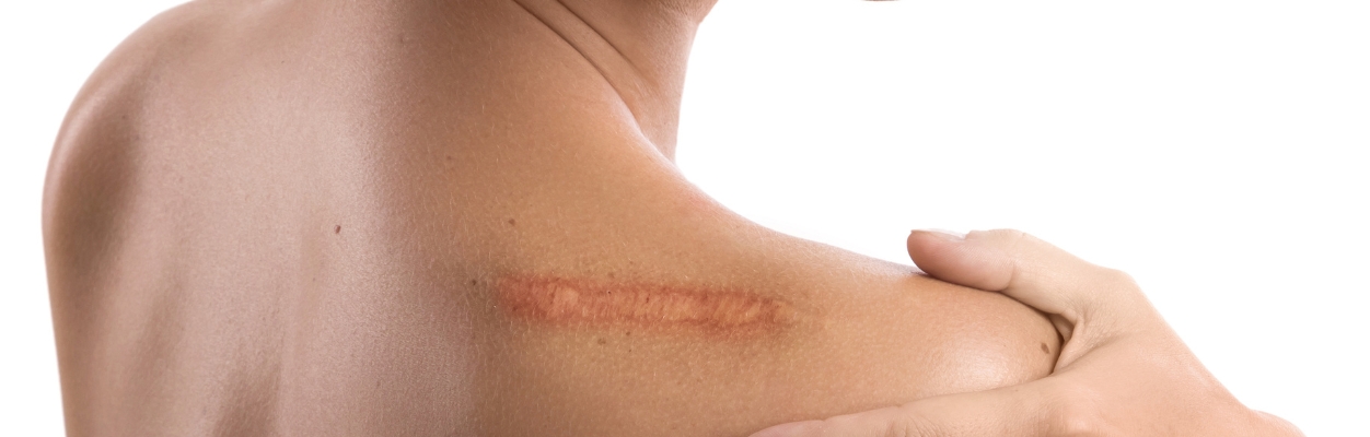 Scar to shoulder